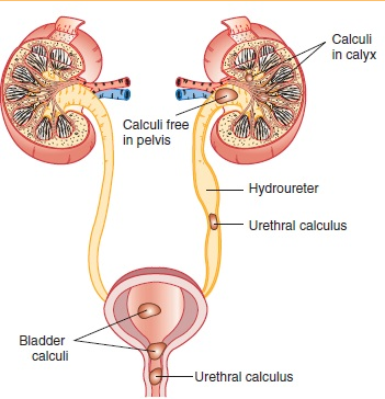 Homeopathic Treatment For Kidney Stones