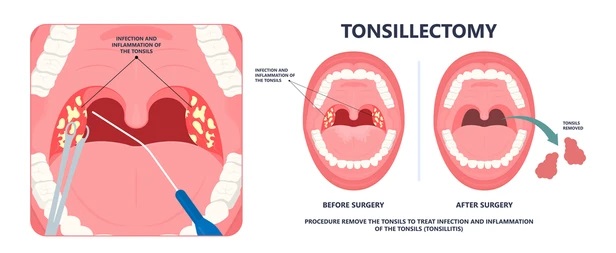 Homeopathy for treatment of Tonsillitis